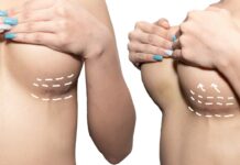 Tips To Treat Breast Reduction Scars