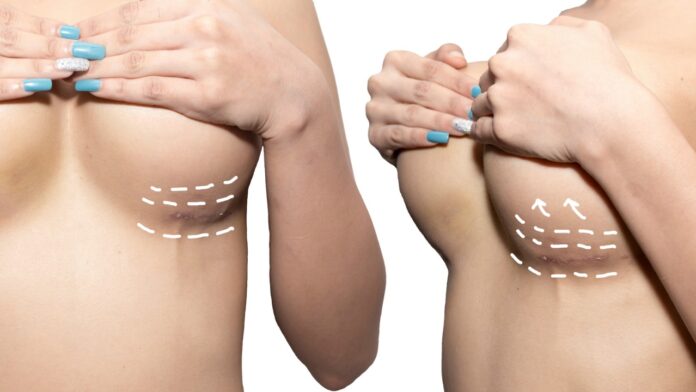 Tips To Treat Breast Reduction Scars