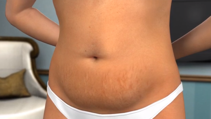 tummy tuck cost