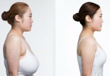 breast reduction surgery