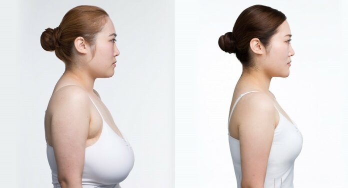 breast reduction surgery