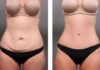 Tummy Tuck Recovery