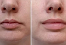 Everything About Lip Implant Cost in Dallas