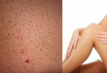 Blackheads On Inner Thighs