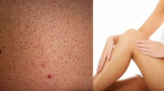 Blackheads On Inner Thighs