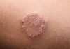 ringworm stages of healing