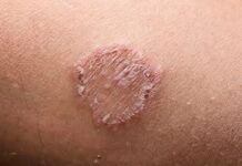 ringworm stages of healing