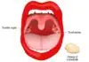 tonsil stones