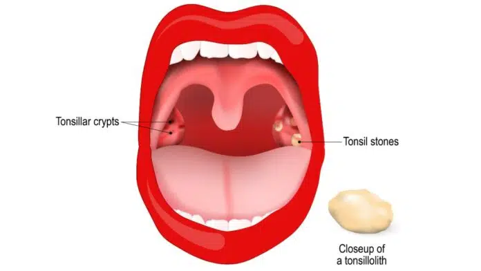 tonsil stones