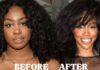 SZA Before and After Surgery