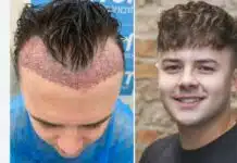 hair transplant dubai