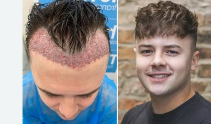 hair transplant dubai