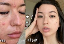 accutane before and after