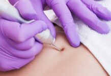 stages of wart falling off