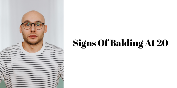 signs of balding at 20