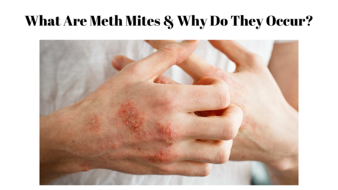 meth mites