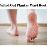 pulled out plantar wart root