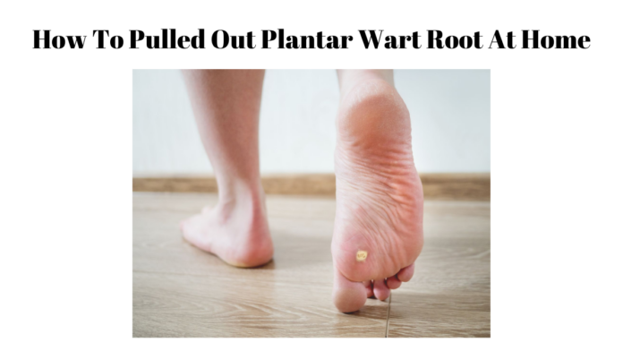 pulled out plantar wart root